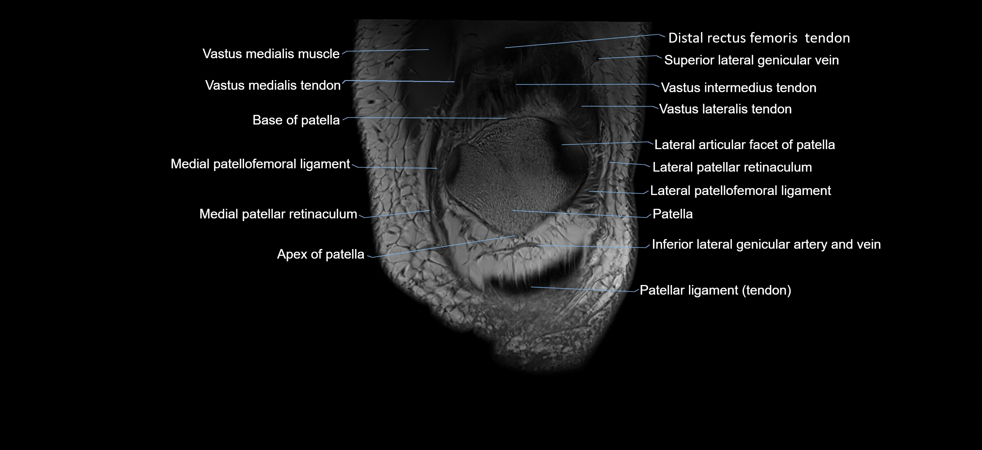 MRI knee coronal cross sectional anatomy labelled 3T radiology  image-04001-00006.webp